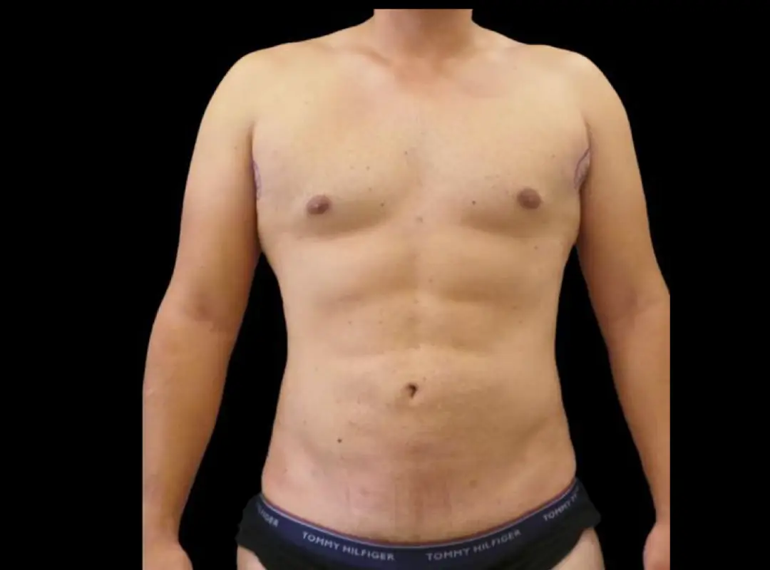Abdominal Liposuction After