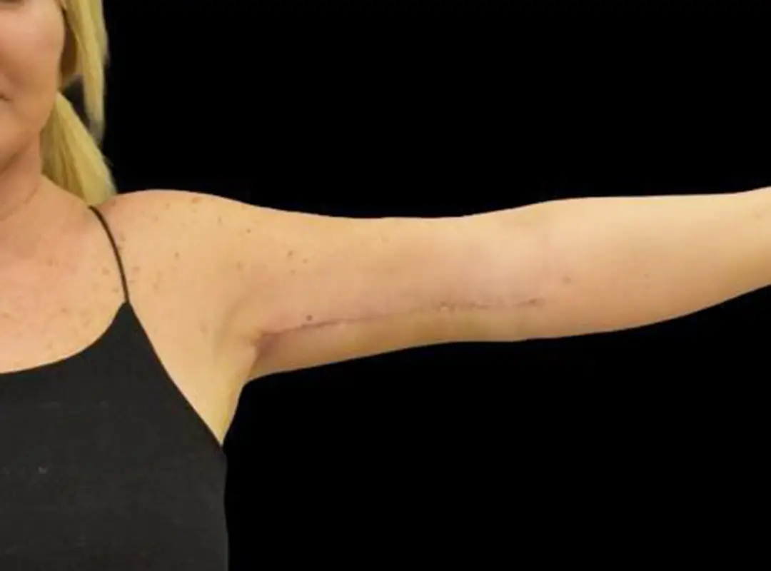 Arm Lift After