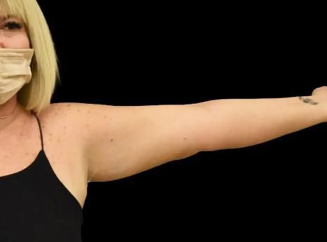 Arm Lift Before