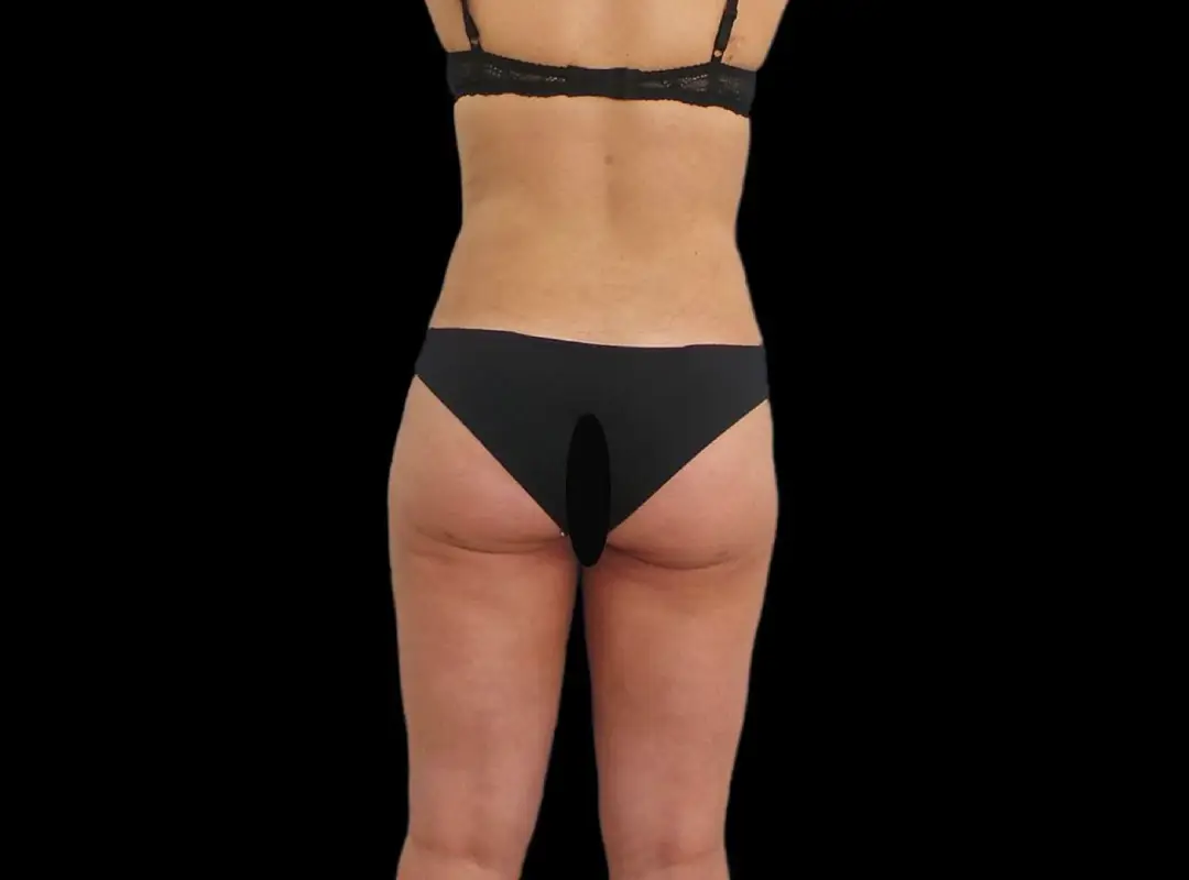 Liposuction After