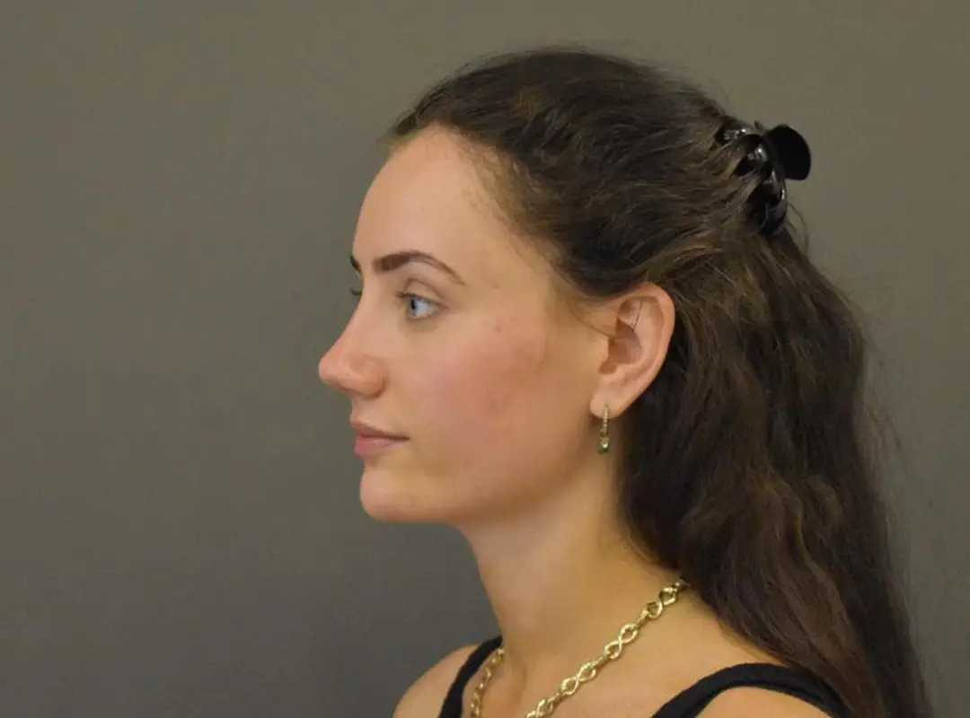 Rhinoplasty After