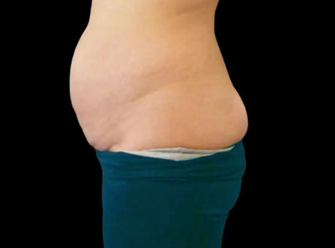 Tummy Tuck Before