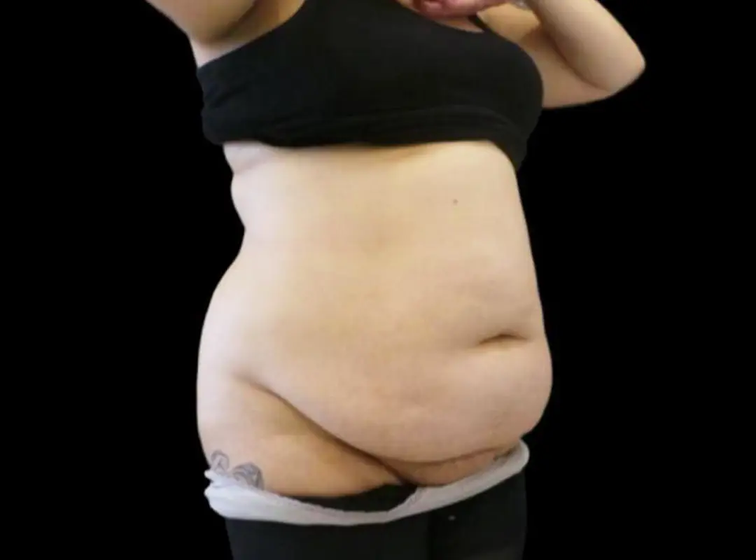 Tummy Tuck and Mommy Before